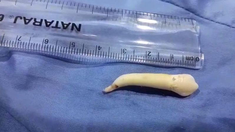 Mladému muži vytrhli rekordně dlouhý zub